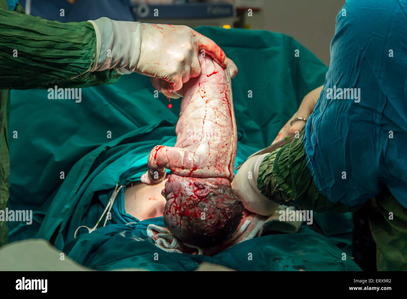childbirth in operation room c-section surgery Stock Photo