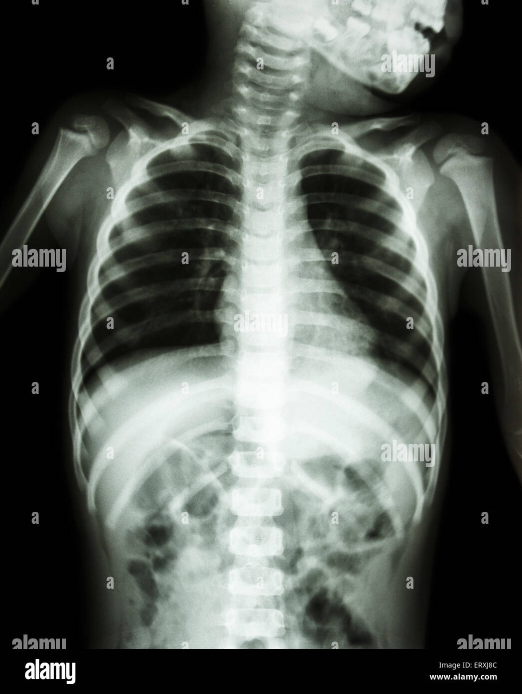 Chest X Ray Of Child Stock Photos & Chest X Ray Of Child Stock Images