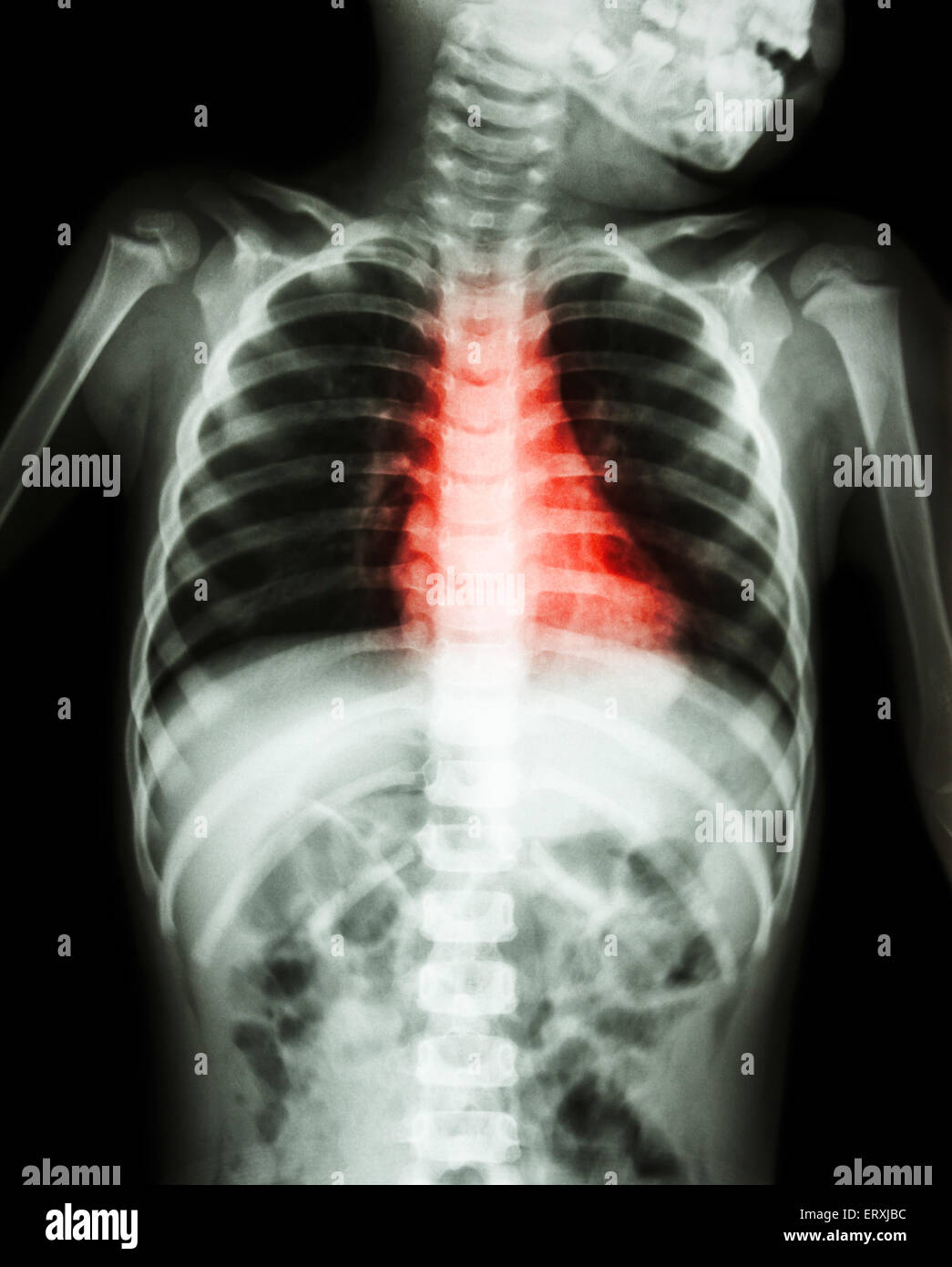 Congenital Heart Disease , Rheumatic Heart Disease ( X-ray body of child  and red color on heart area Stock Photo - Alamy