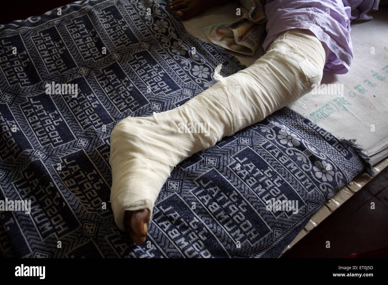 Injured foot ; Victim of terrorist attack by Deccan Mujahedeen on 26th November 2008 treated in J.J. hospital in Bombay Stock Photo