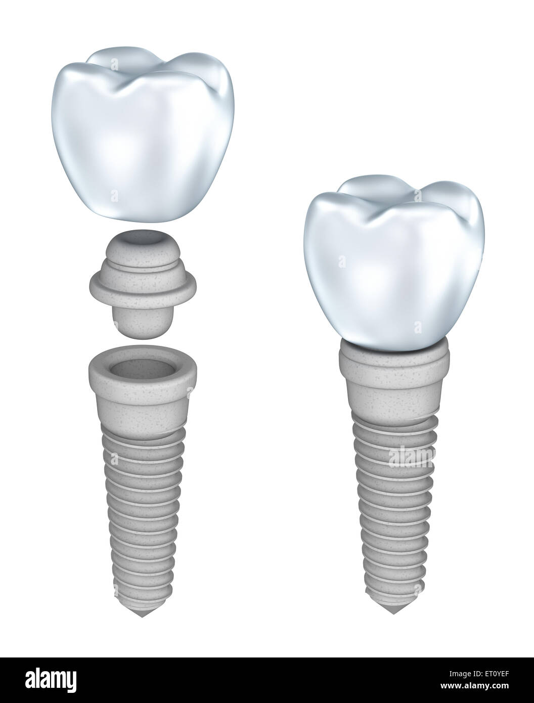 Dental implant isolated on white Stock Photo - Alamy