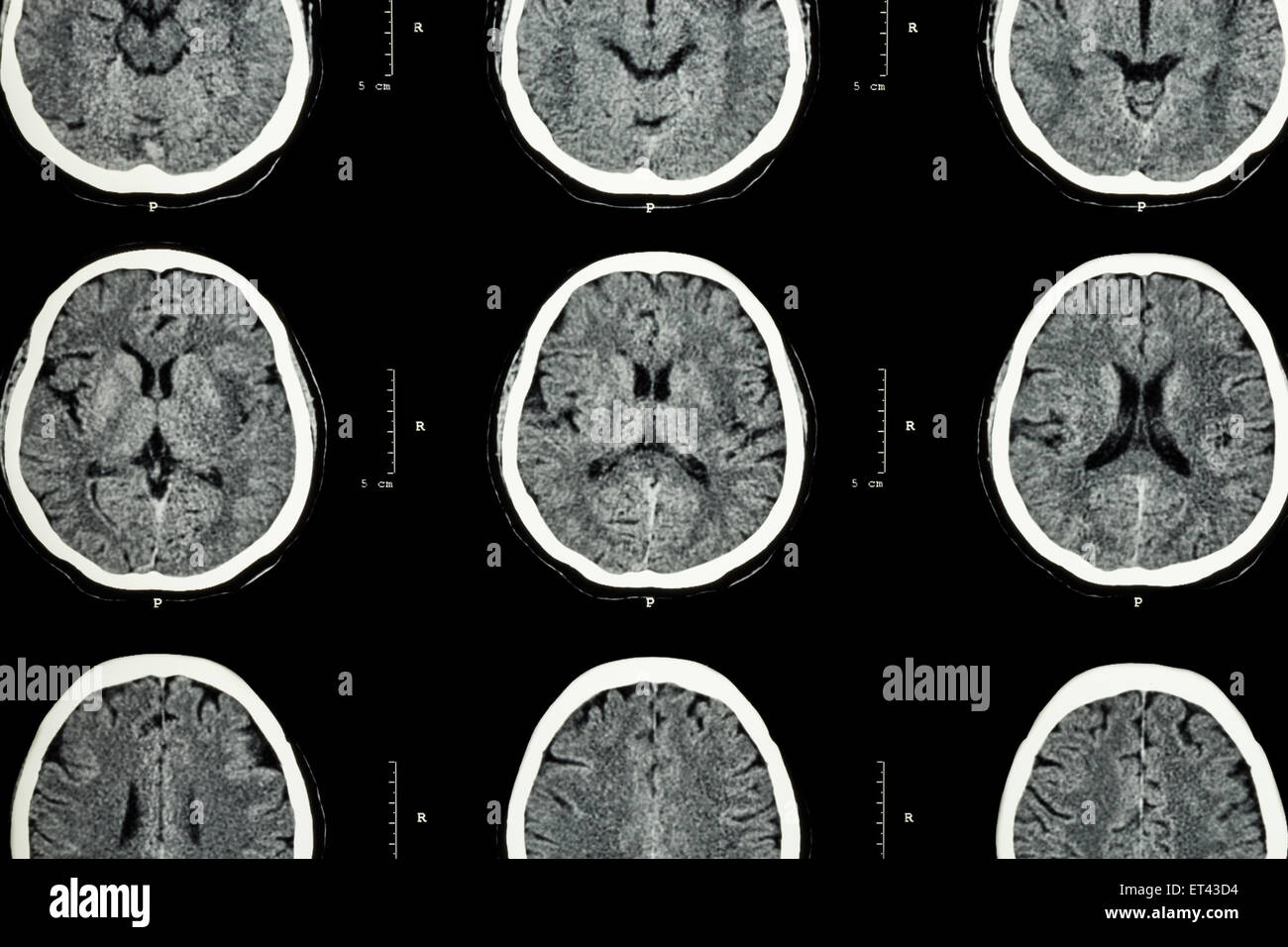 Ct Scan Of Brain Show Normal Brain Neurological Background Stock