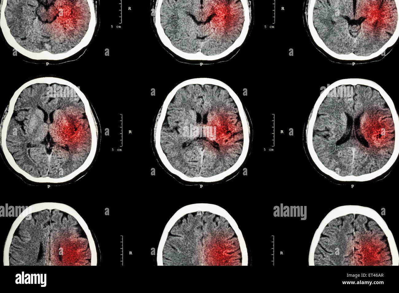 Ct Scan Brain Hemorrhage Ct Scan Machine Images