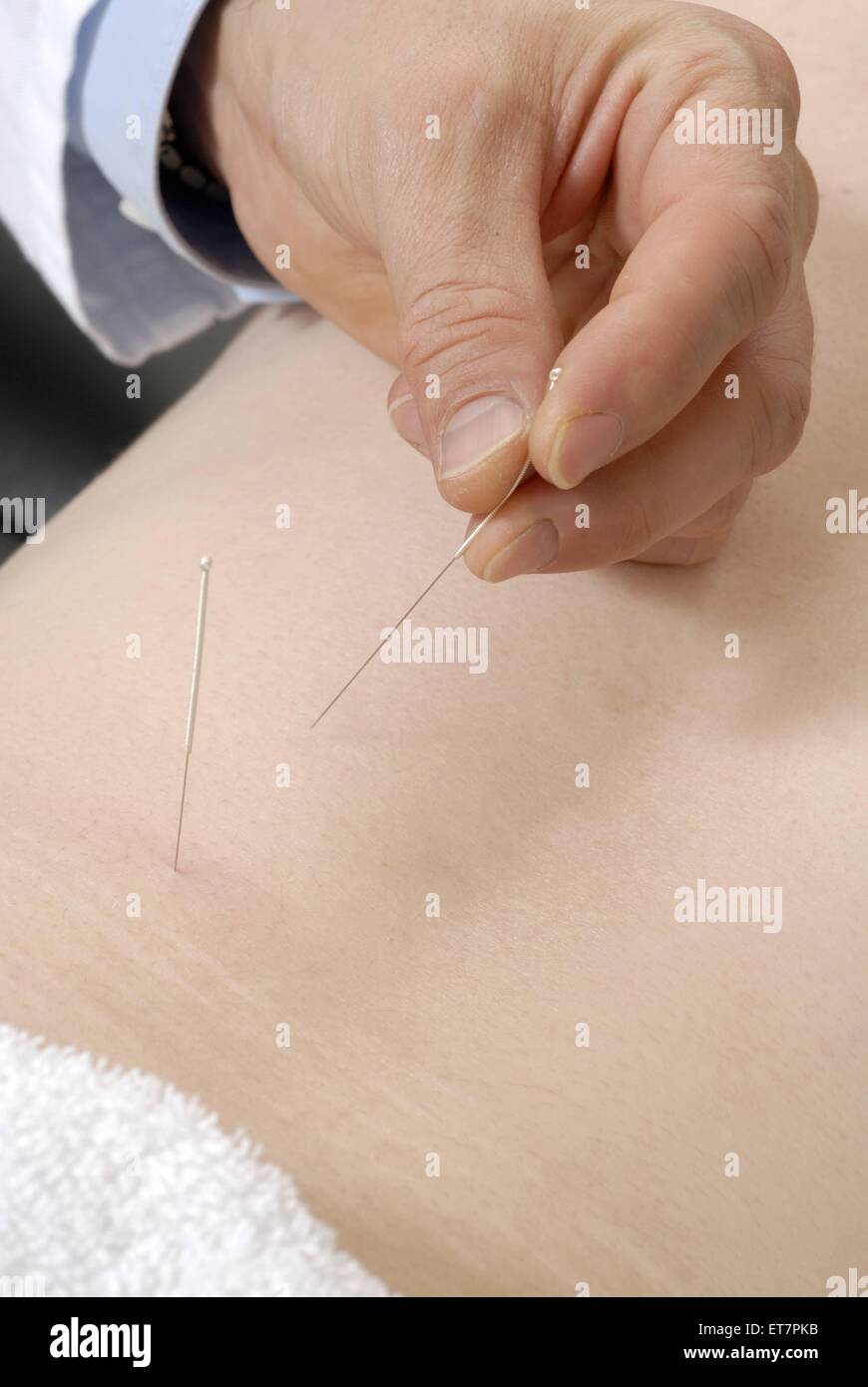 Akupunkturnadeln werden im Ruecken gesetzt | Acupuncture Needles on the Back Stock Photo