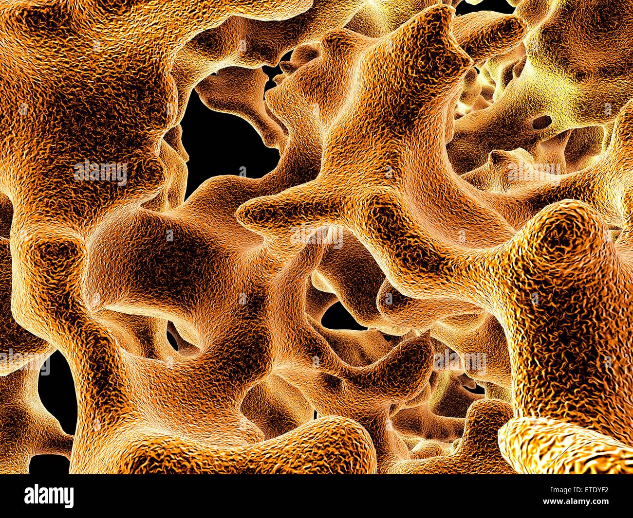 Osteoporosis. Computer artwork of the trabeculae in the cancellous (spongy) bone tissue affected by osteoporosis. The cancellous tissue fills the interior of the bones and in osteoporosis its density decreases, increasing the brittleness of the bones and Stock Photo