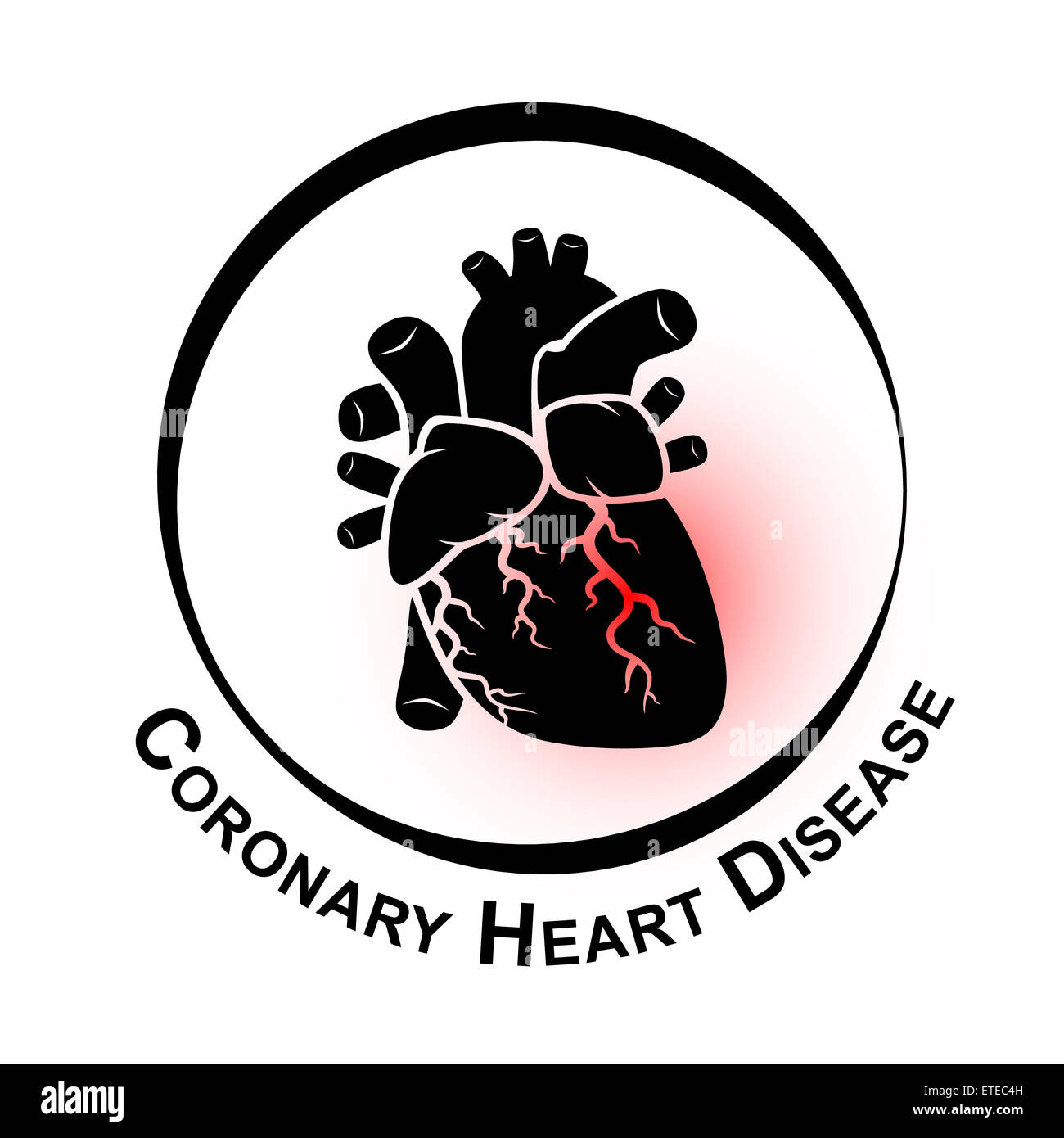 Coronary Heart Disease Symbol ( Ischemic heart disease , Myocardial infraction ) red area at coronary artery ( Thrombus occlude Stock Photo