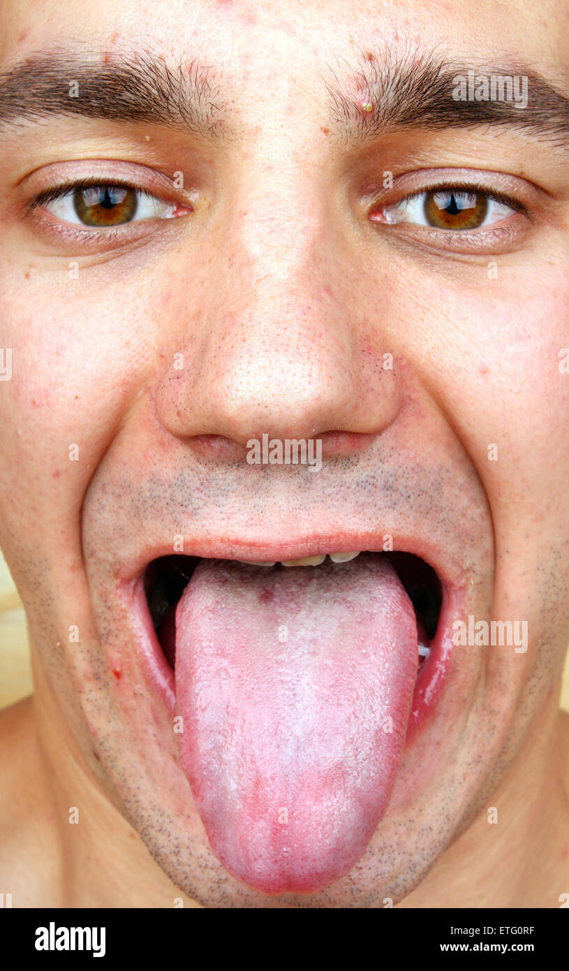 tongue-disease