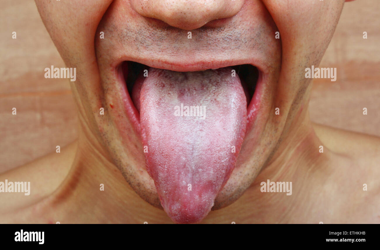 Infection tongue disease candida albicans Stock Photo