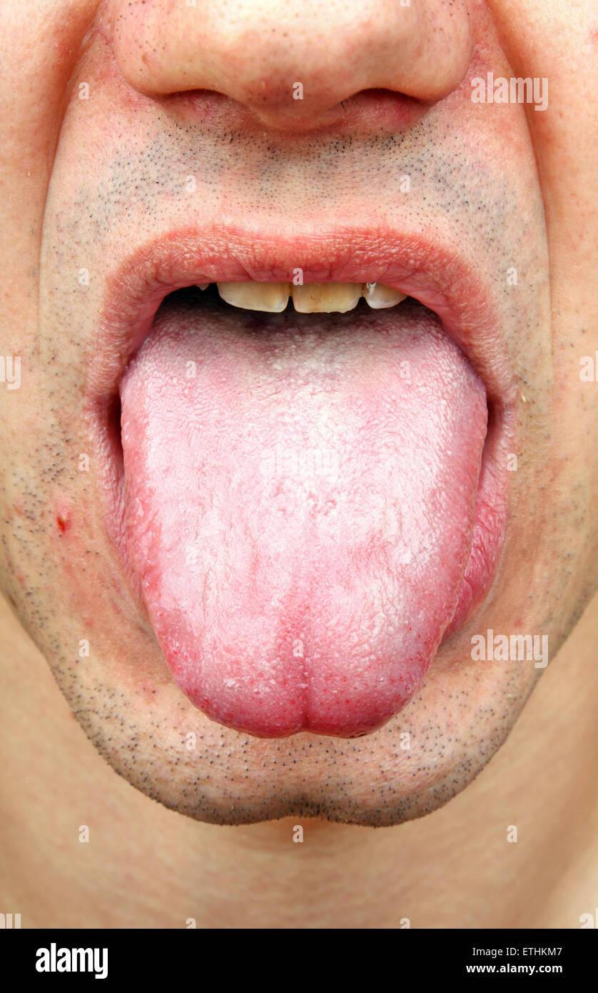 Fungal Infection On Tongue
