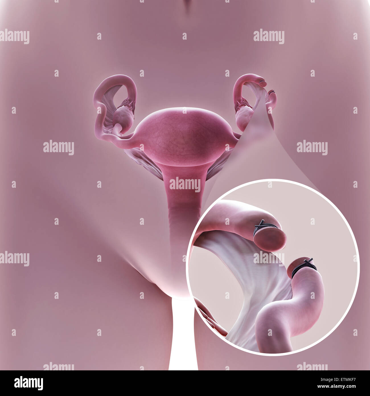 Illustration showing tubal ligation of the Fallopian tube by method