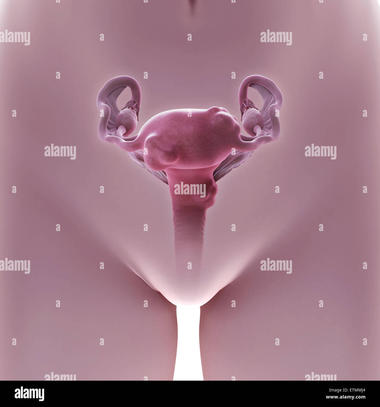 Illustration of a womb afflicted with uterine fibroids, benign tumors of the uterus. Stock Photo