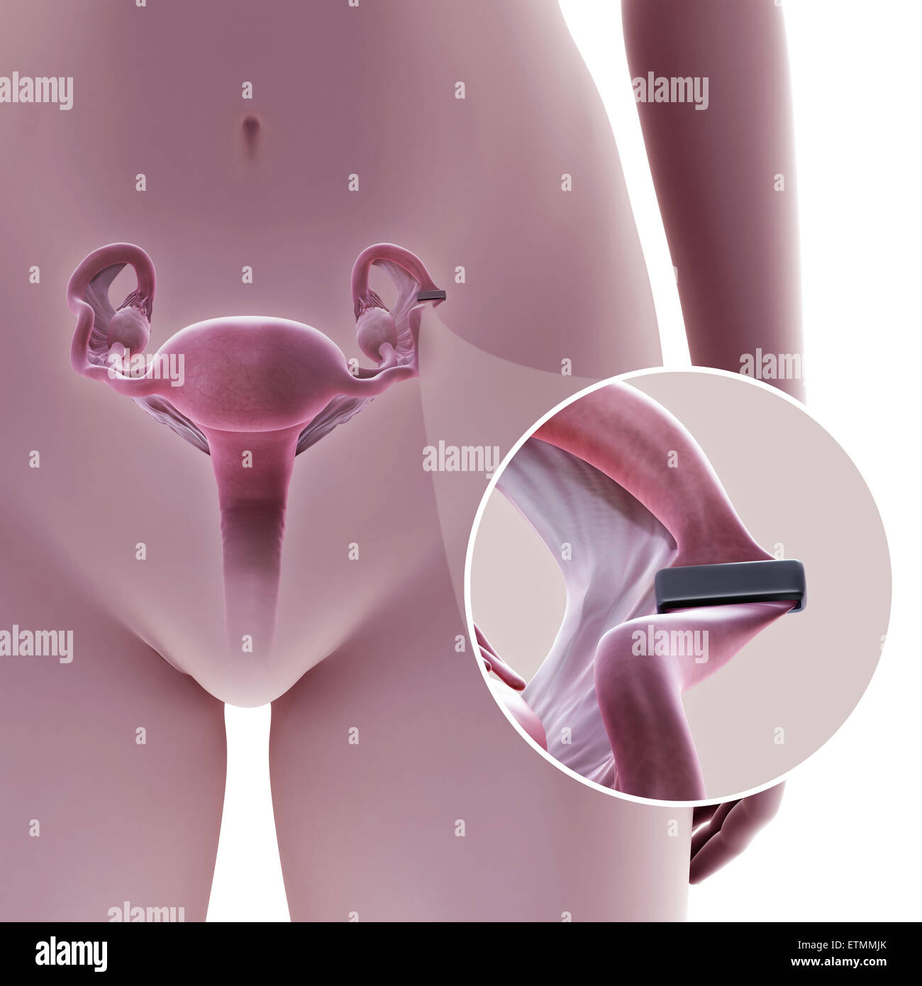Illustration showing tubal ligation of the Fallopian tube by method of a clip, used to block the tube and prevent fertilization. Stock Photo