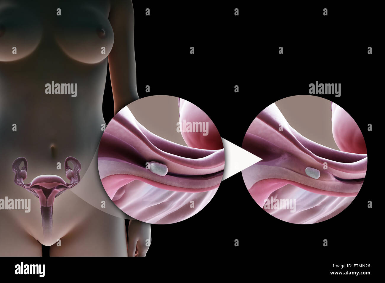 Illustration showing tubal ligation of the Fallopian tube by method of a silicone implant, used to block the tube by the growth of scar tissue and prevent fertilization. Stock Photo
