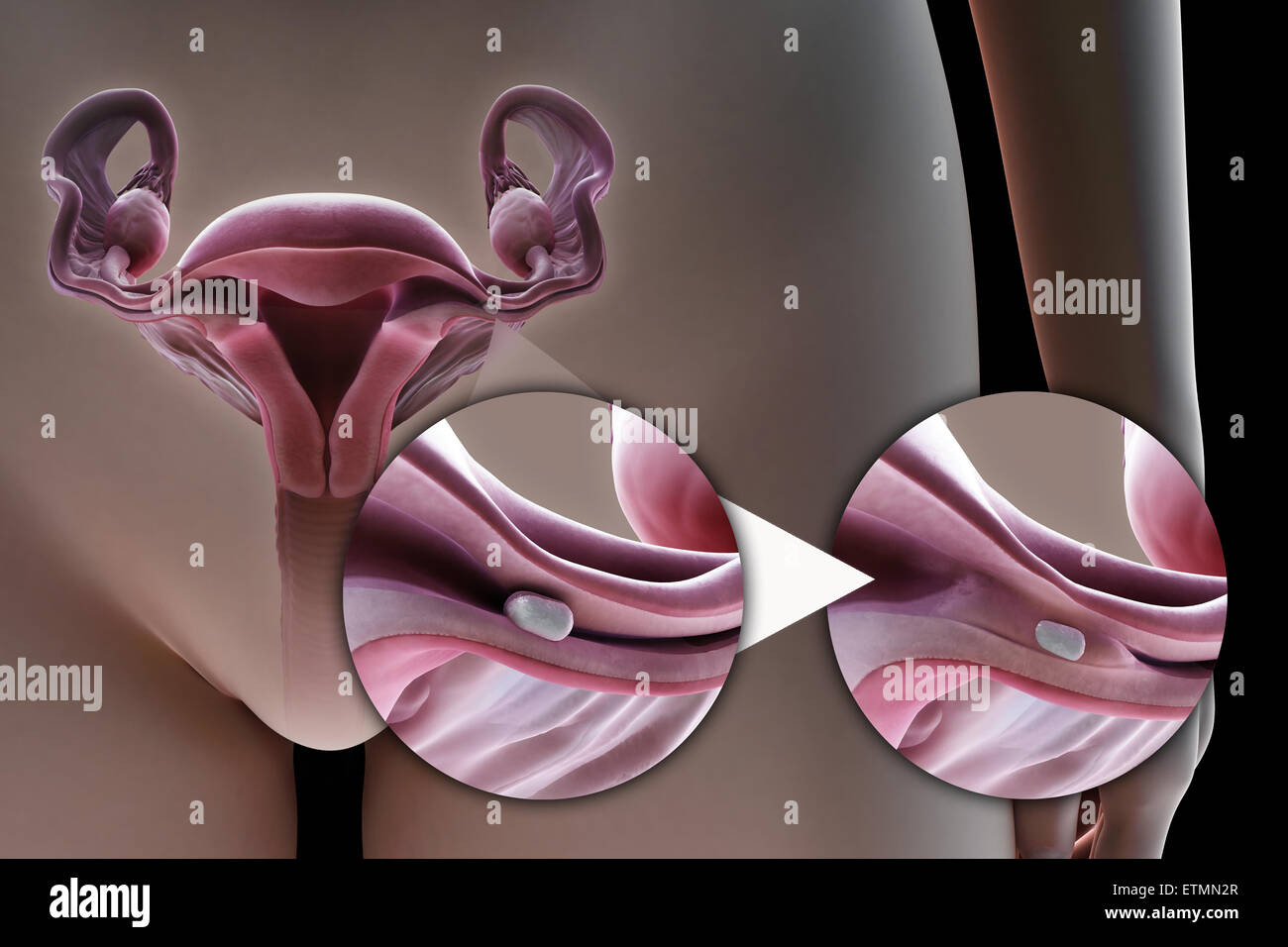 Illustration showing tubal ligation of the Fallopian tube by method of a silicone implant, used to block the tube by the growth of scar tissue and prevent fertilization. Stock Photo