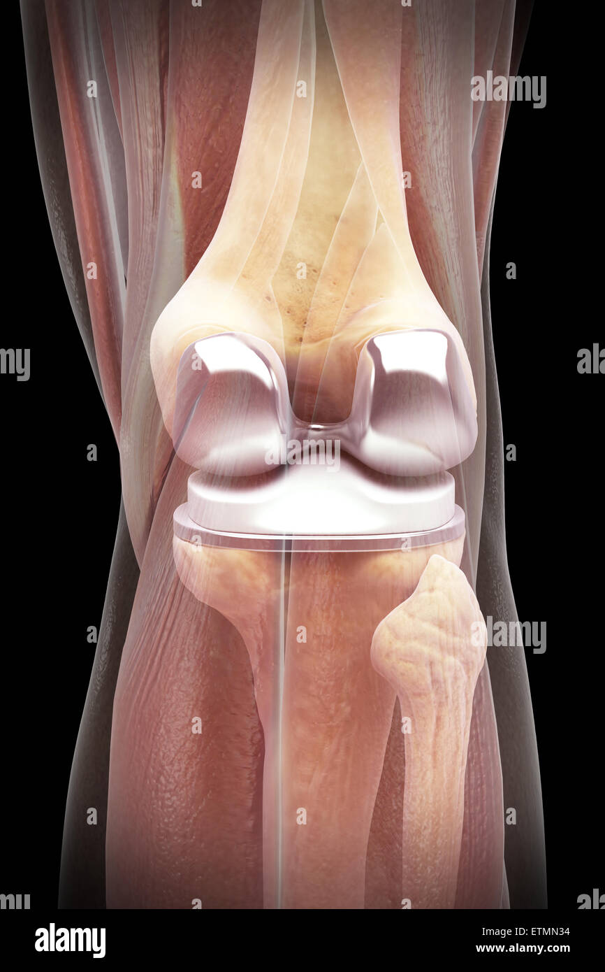 Illustration showing a knee replacement with transparent muscle. Stock Photo