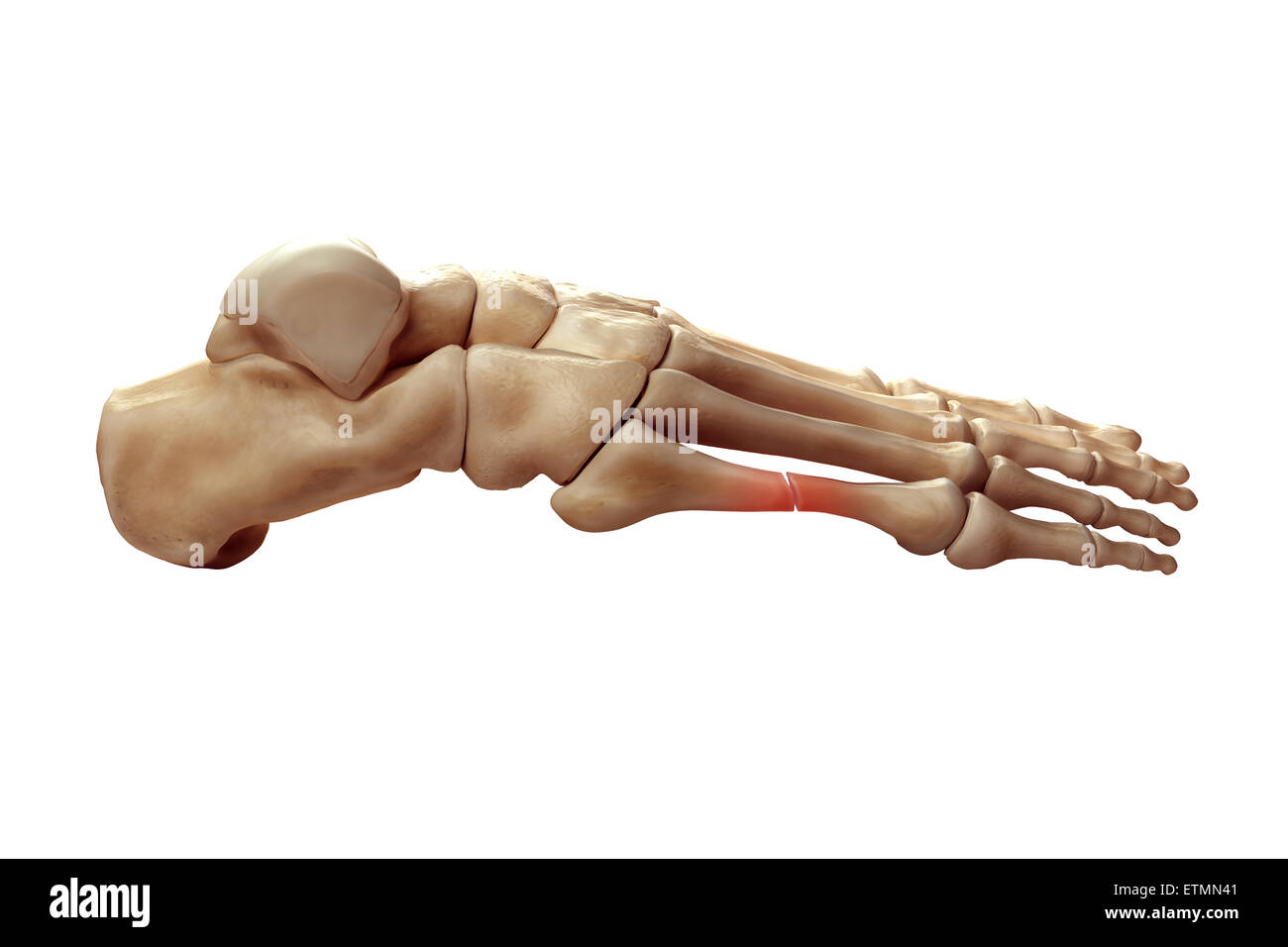 Illustration showing the bones of the foot with a break in a metatarsal highlighted. Stock Photo