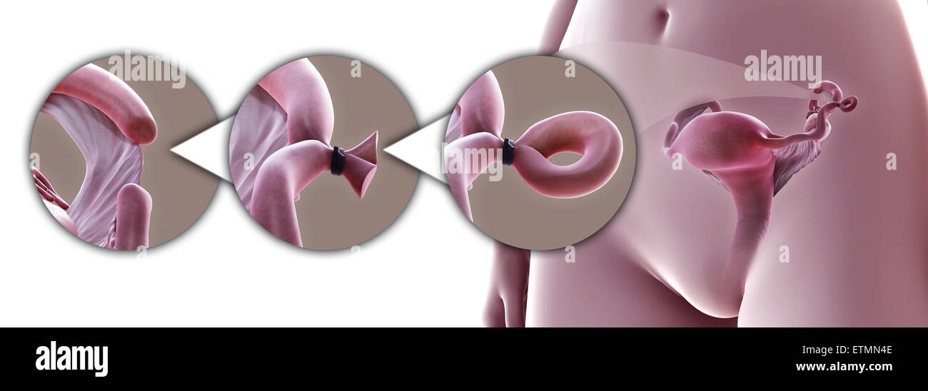 Illustration showing tubal ligation of the Fallopian tube by Pomeroy method, which removes a section of the tube to prevent fertilization. Stock Photo