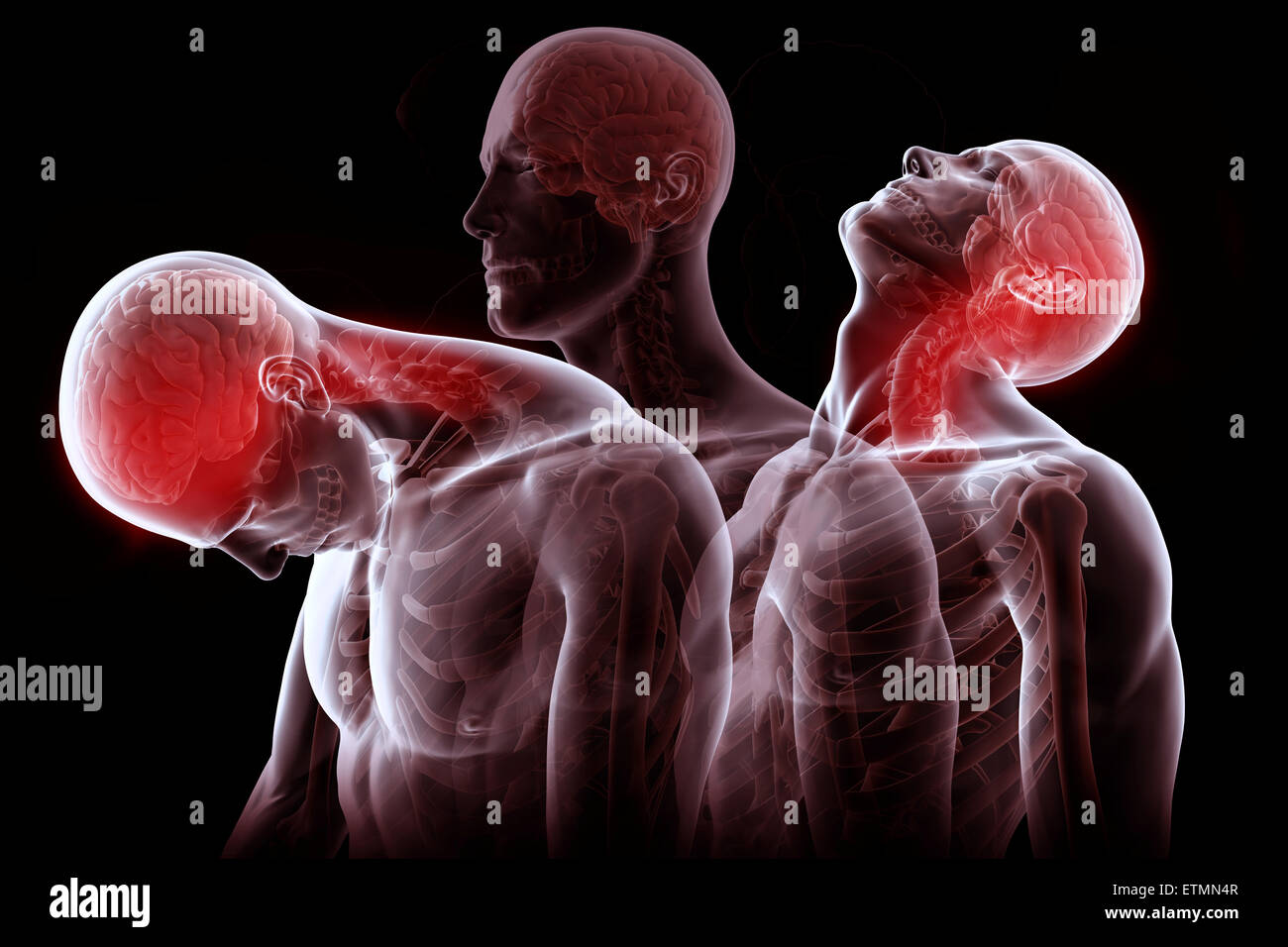 Conceptual illustration showing the stages of motion that cause whiplash: retraction, extension and rebound. Stock Photo