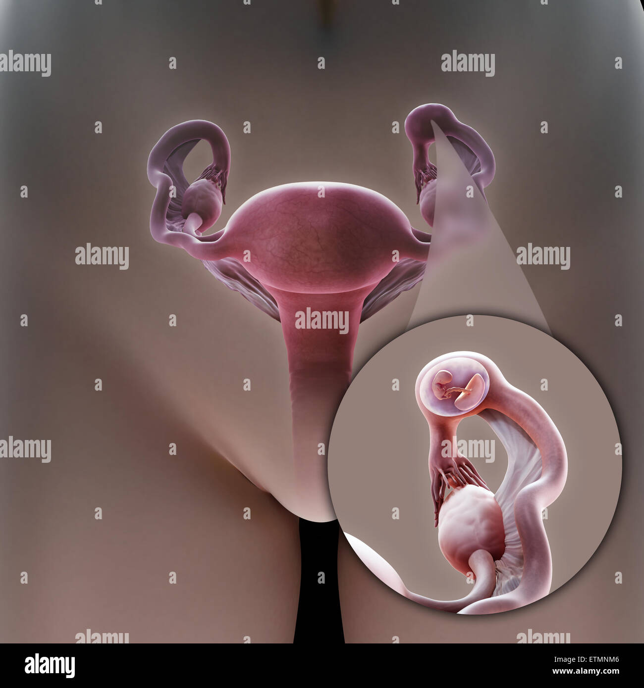 Illustration of the female reproduction system during an ectopic pregnancy location in the ampulla section of the Fallopian tube, a zoomed out section shows the embryo. Stock Photo