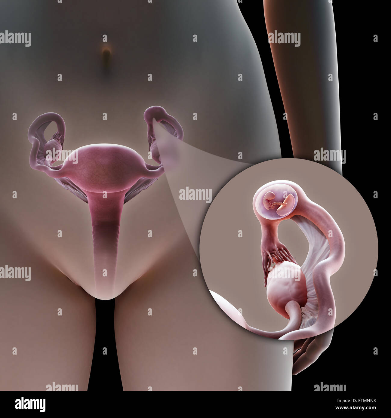Illustration of the female reproduction system during an ectopic pregnancy location in the ampulla section of the Fallopian tube, a zoomed out section shows the embryo. Stock Photo