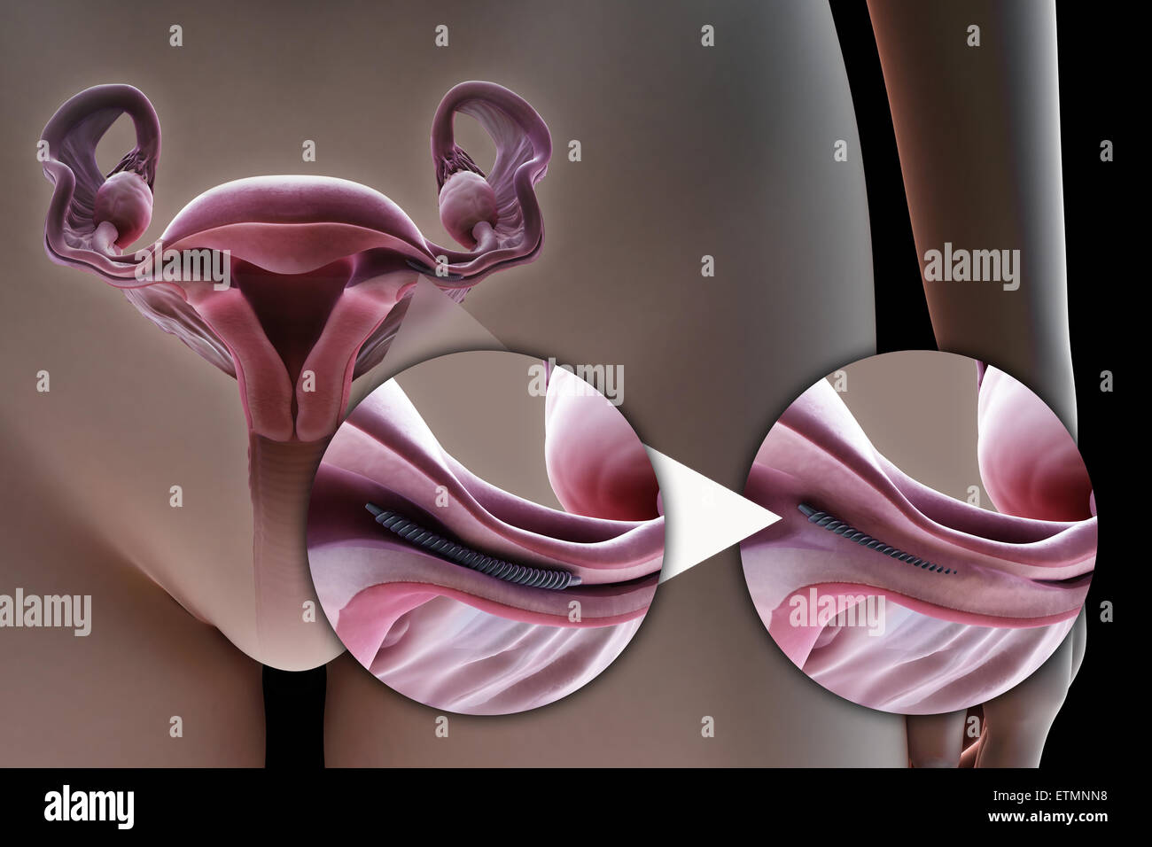 Illustration showing tubal ligation of the Fallopian tube by method of a metal implant, used to block the tube by the growth of scar tissue and prevent fertilization. Stock Photo