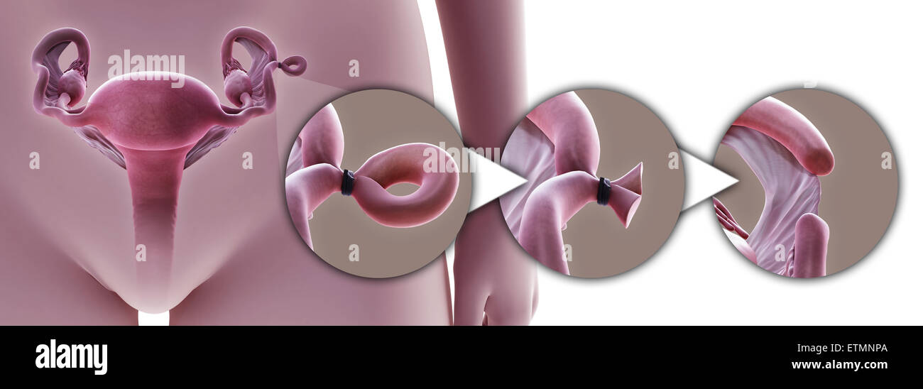 Illustration showing tubal ligation of the Fallopian tube by Pomeroy method, which removes a section of the tube to prevent fertilization. Stock Photo