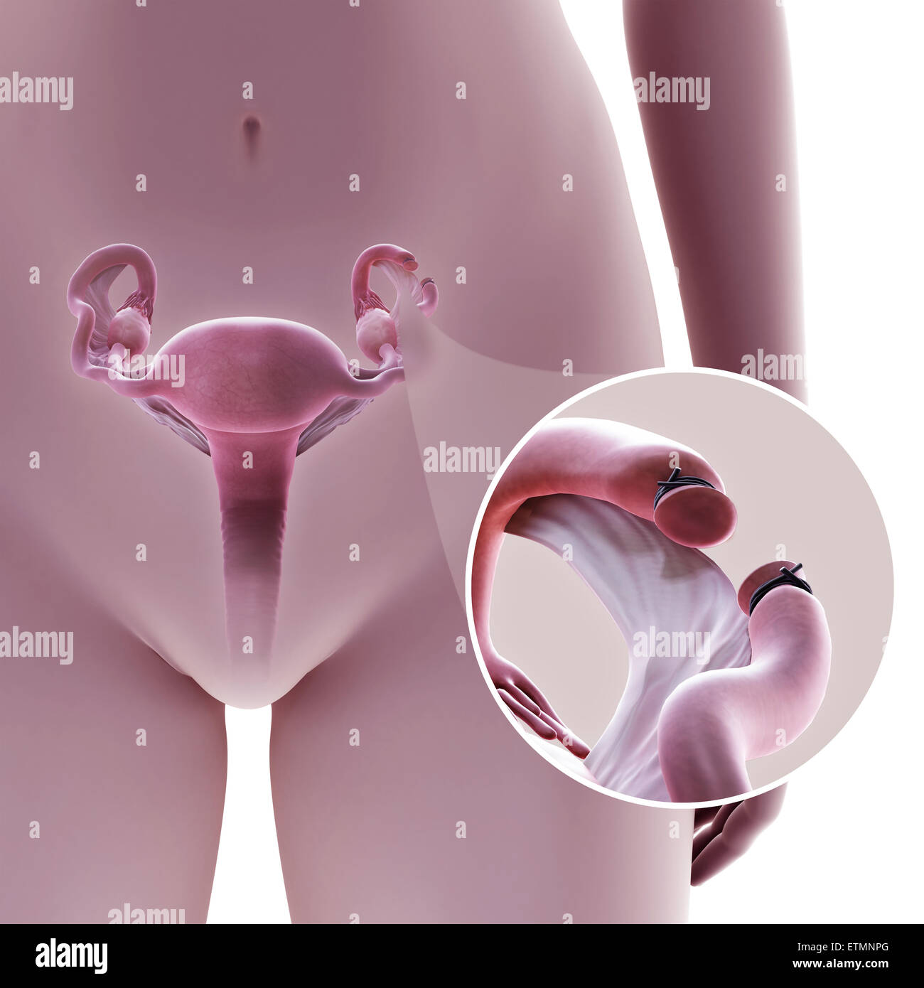 Illustration showing tubal ligation of the Fallopian tube by method resection, where a section of the tube is removed to prevent fertilization. Stock Photo