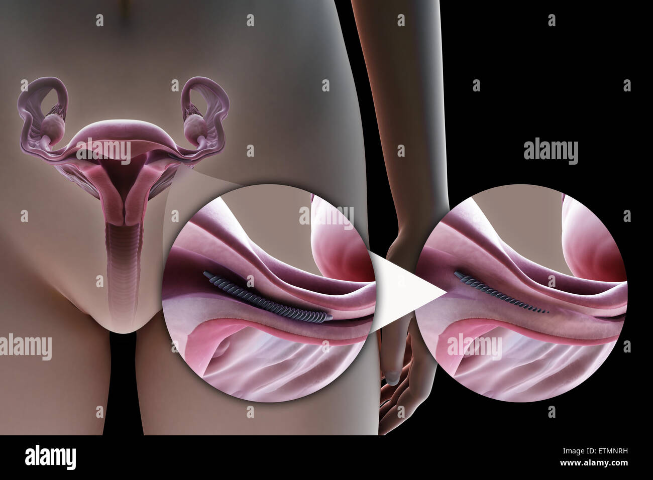 Illustration showing tubal ligation of the Fallopian tube by method of a metal implant, used to block the tube by the growth of scar tissue and prevent fertilization. Stock Photo