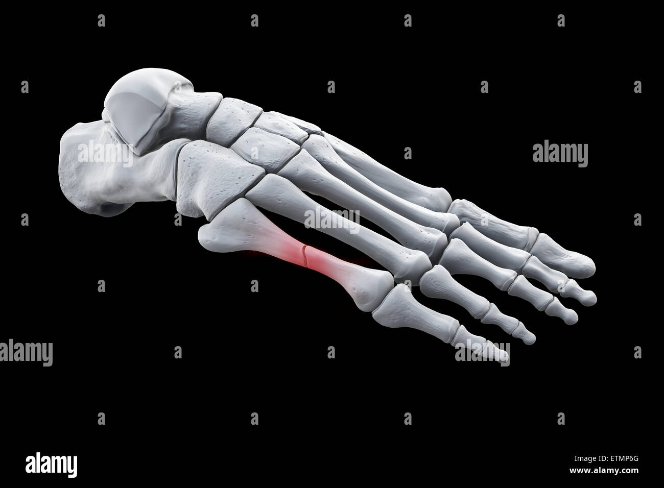 Illustration showing the bones of the foot with a break in a metatarsal highlighted. Stock Photo