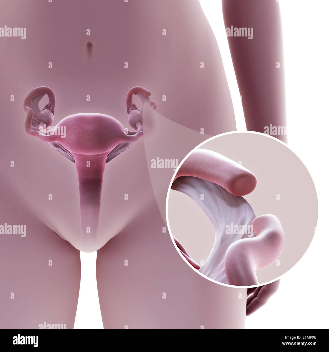 Illustration showing tubal ligation of the Fallopian tube by method of