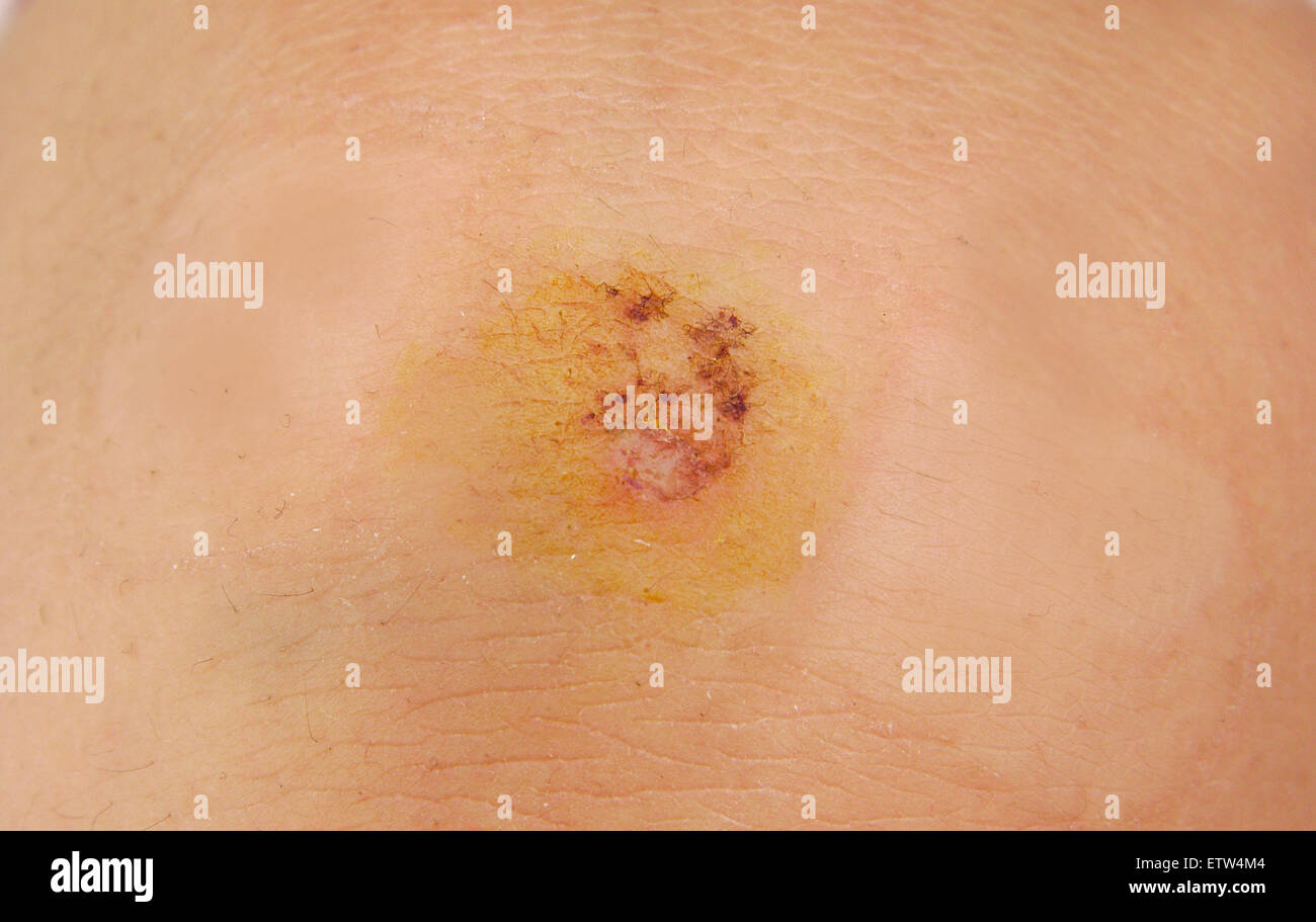 Scrapped knee hires stock photography and images Alamy