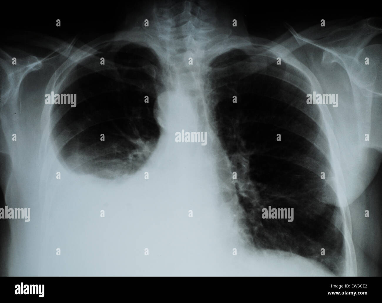 X-Ray Image Of Human Chest for a medical exam by the Doctors Stock Photo