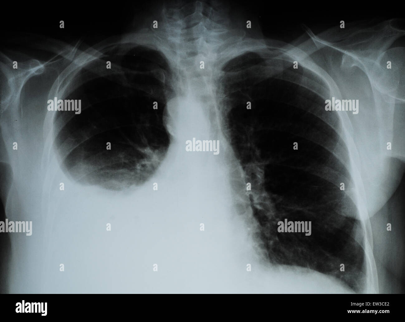 XRay Image Of Human Chest for a medical exam by the Doctors Stock