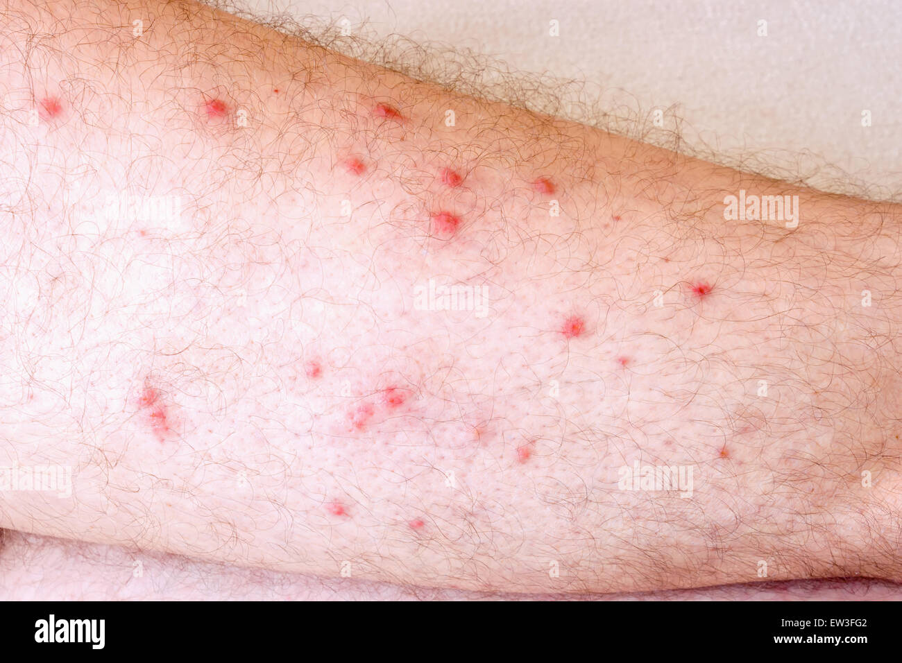 Allergy on legs Stock Photo