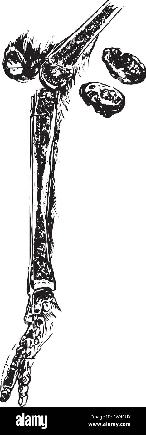 Osteomyelitis involving the tibia, vintage engraved illustration. Stock Vector