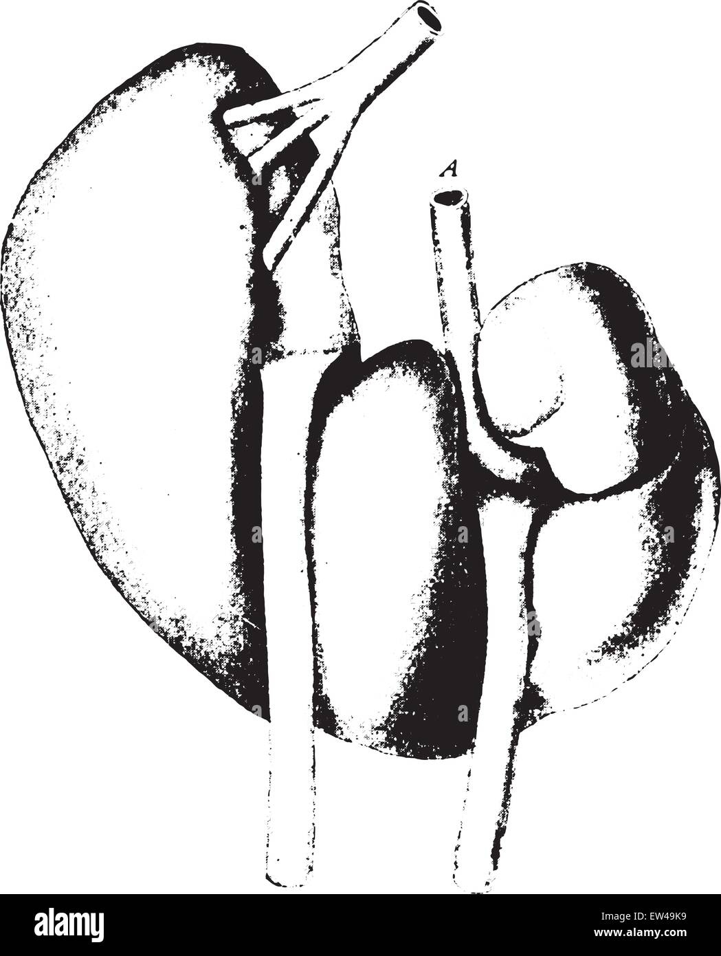 Horseshoe kidney, vintage engraved illustration. Stock Vector