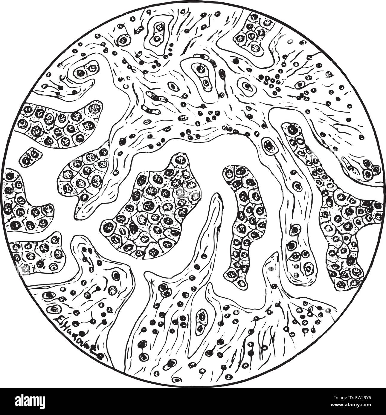 Glandular carcinoma of the liver, vintage engraved illustration Stock