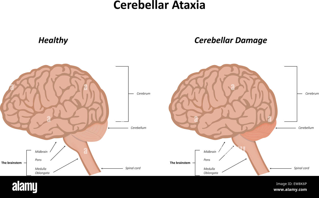 Cerebellar Ataxia Stock Photo