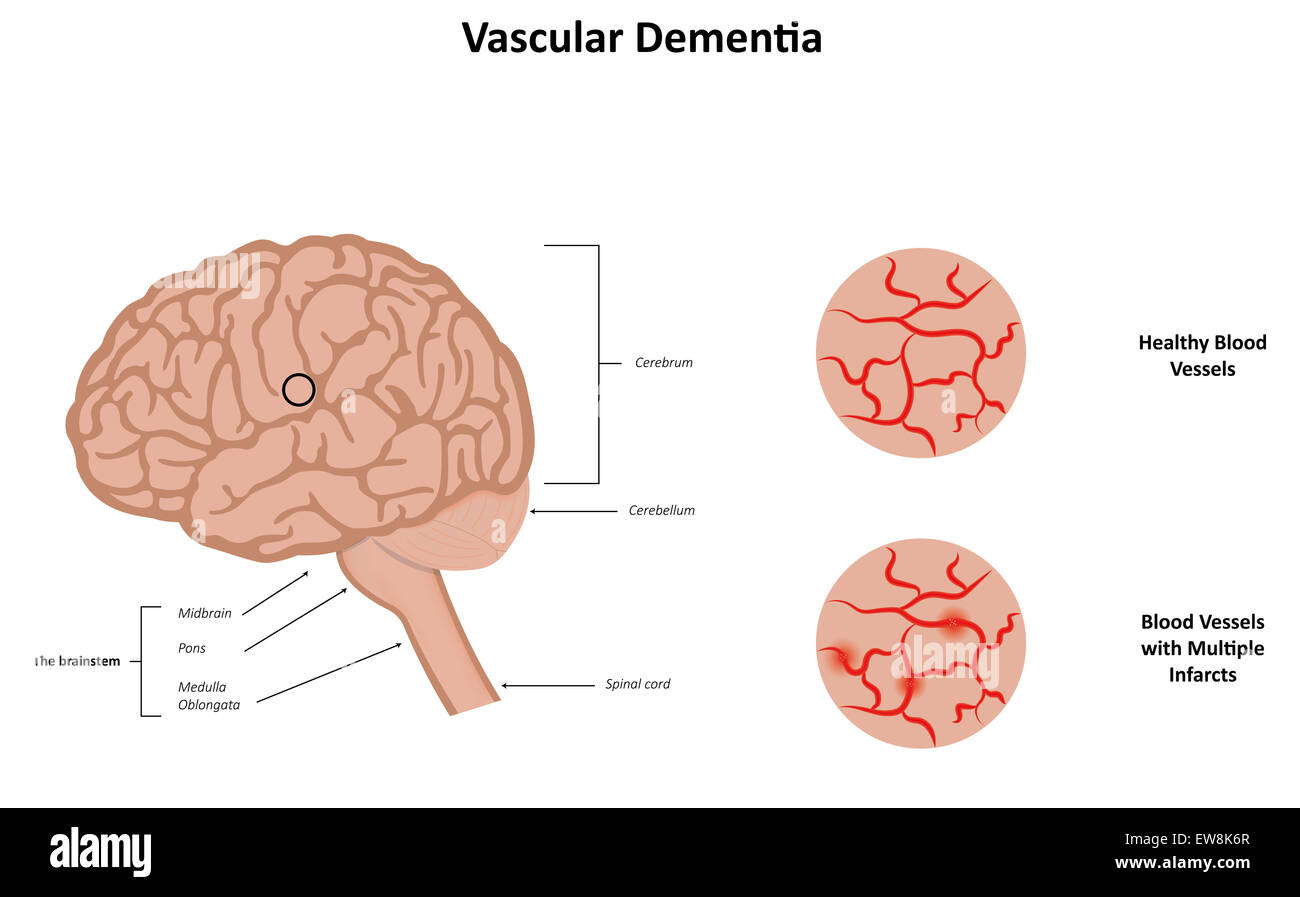 Vascular Dementia High Resolution Stock Photography and Images Alamy