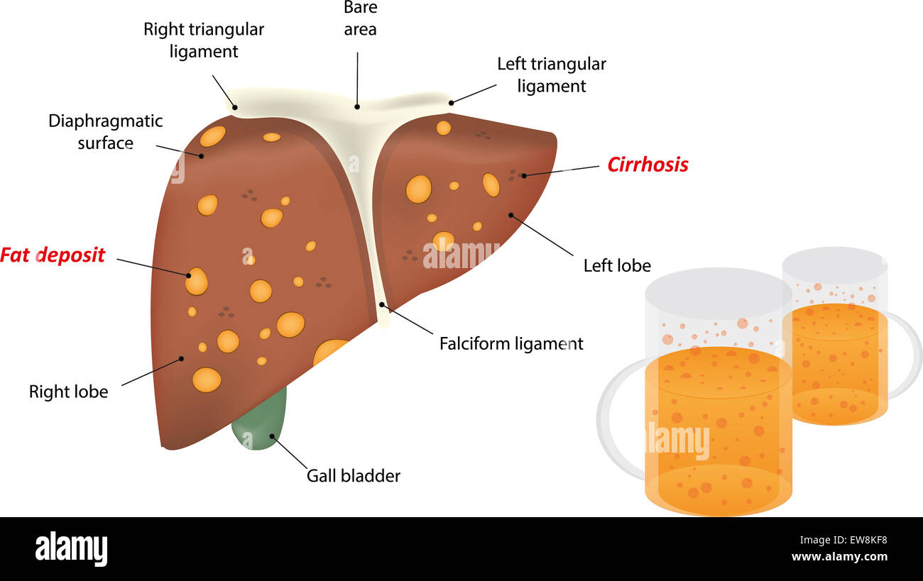 Cirrhosis As Related To Alcoholic Liver Disease Pictures