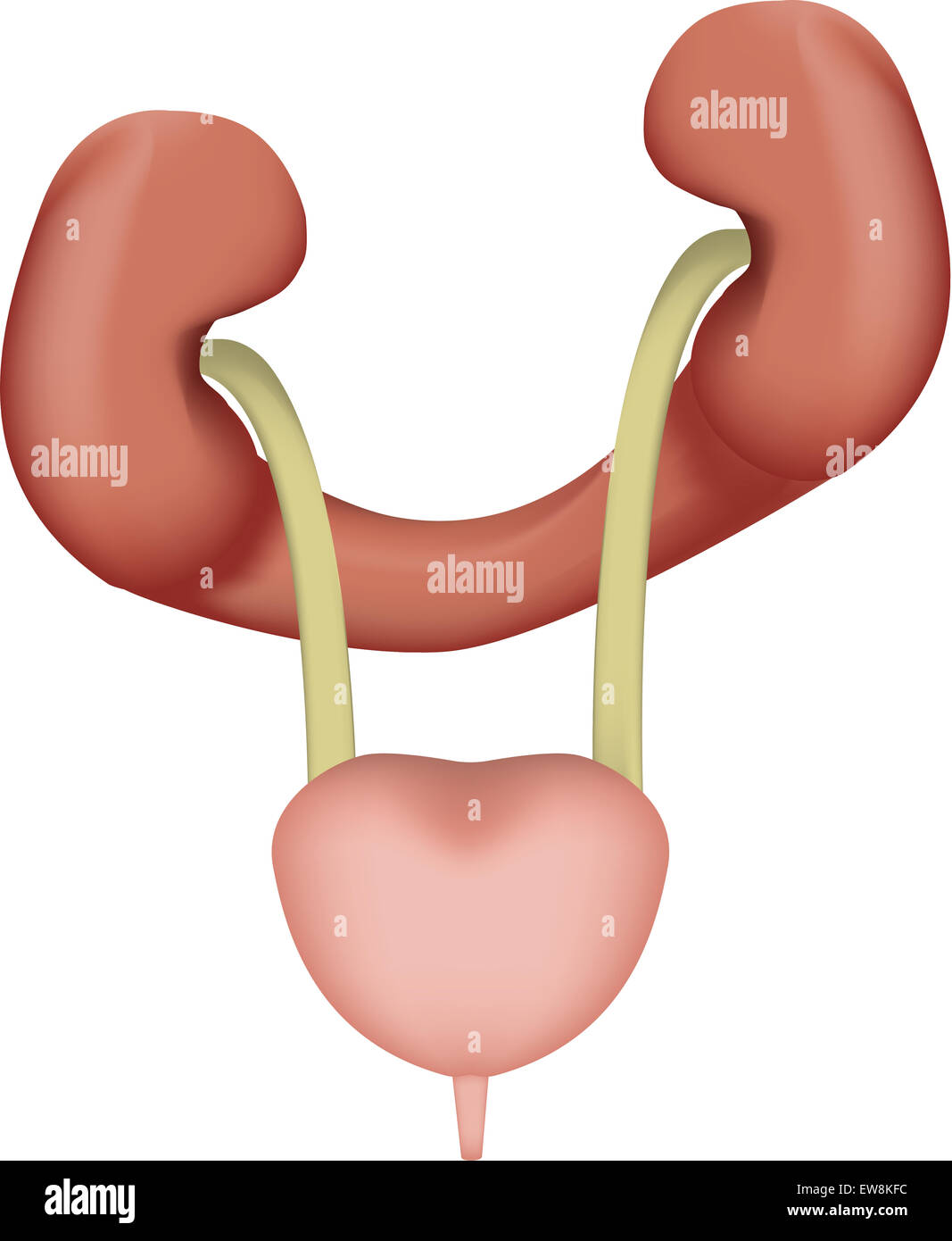 Understanding Horseshoe Kidney