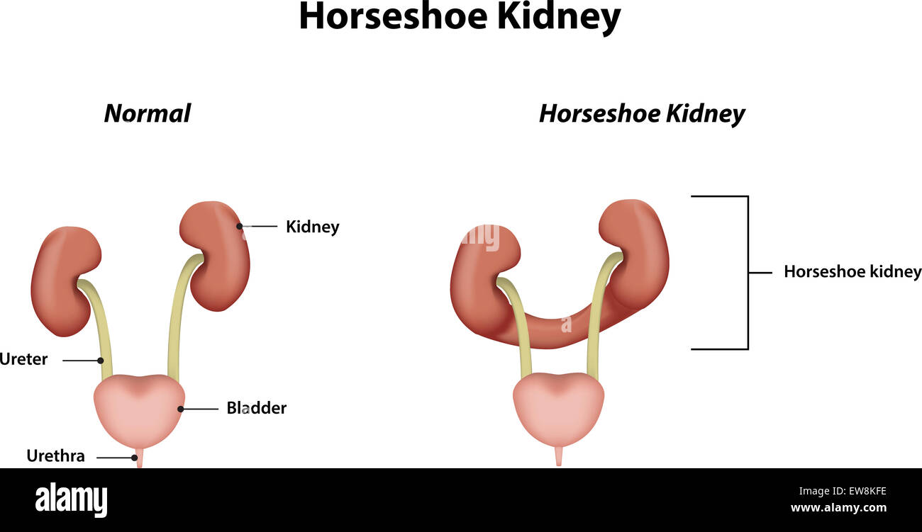 Horseshoe kidney hi-res stock photography and images - Alamy