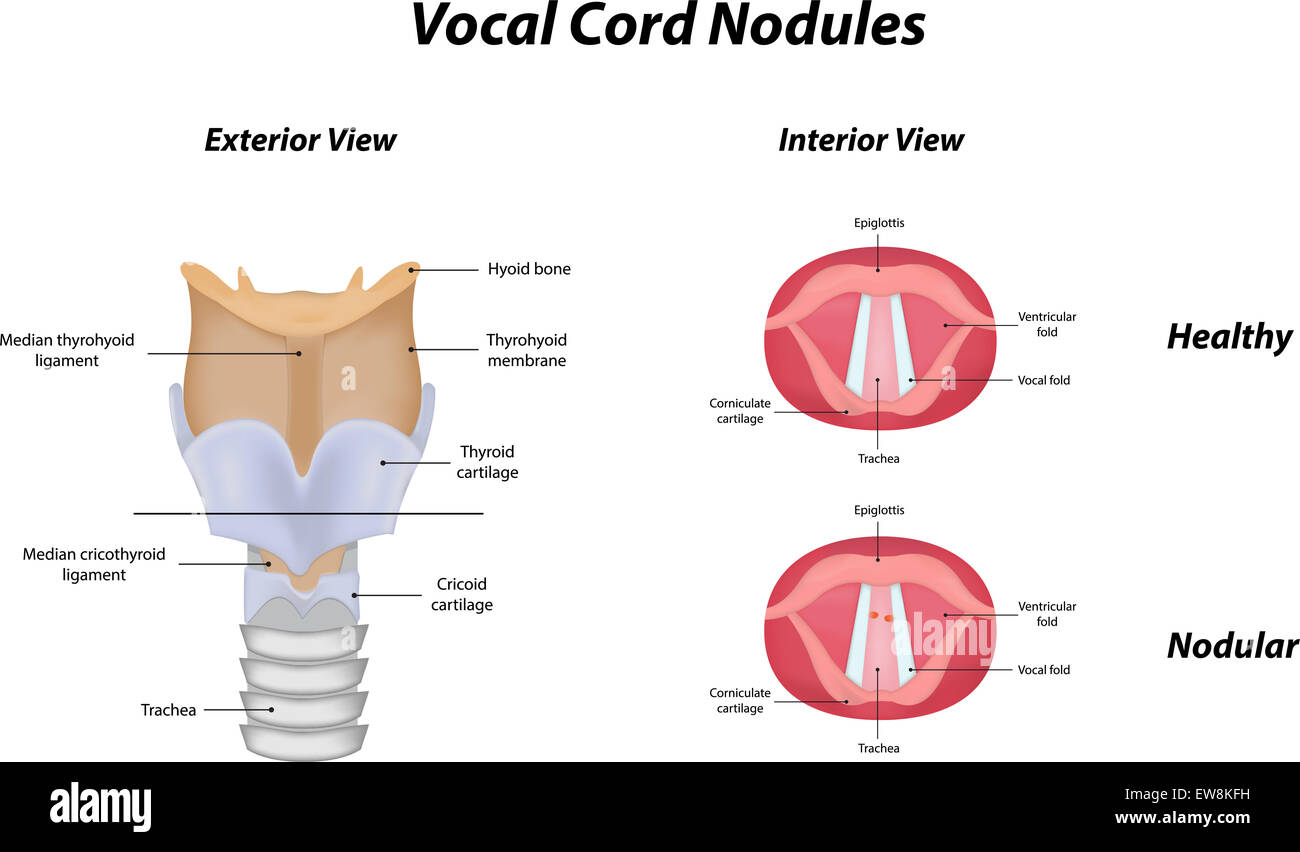 Vocal Cord Nodules Stock Photo