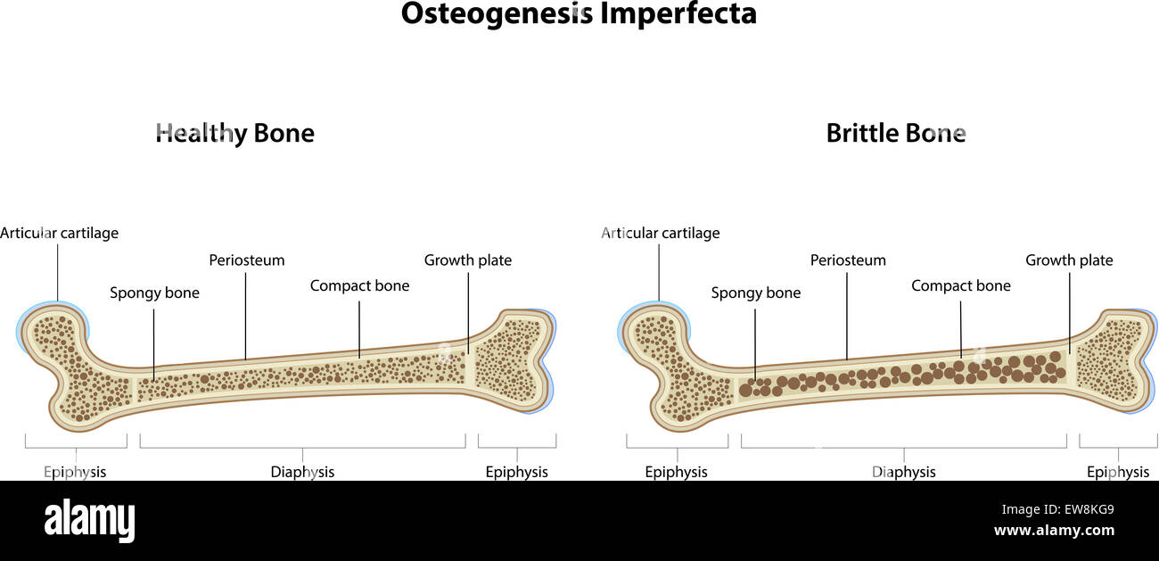 Osteogenesis imperfecta hires stock photography and images Alamy