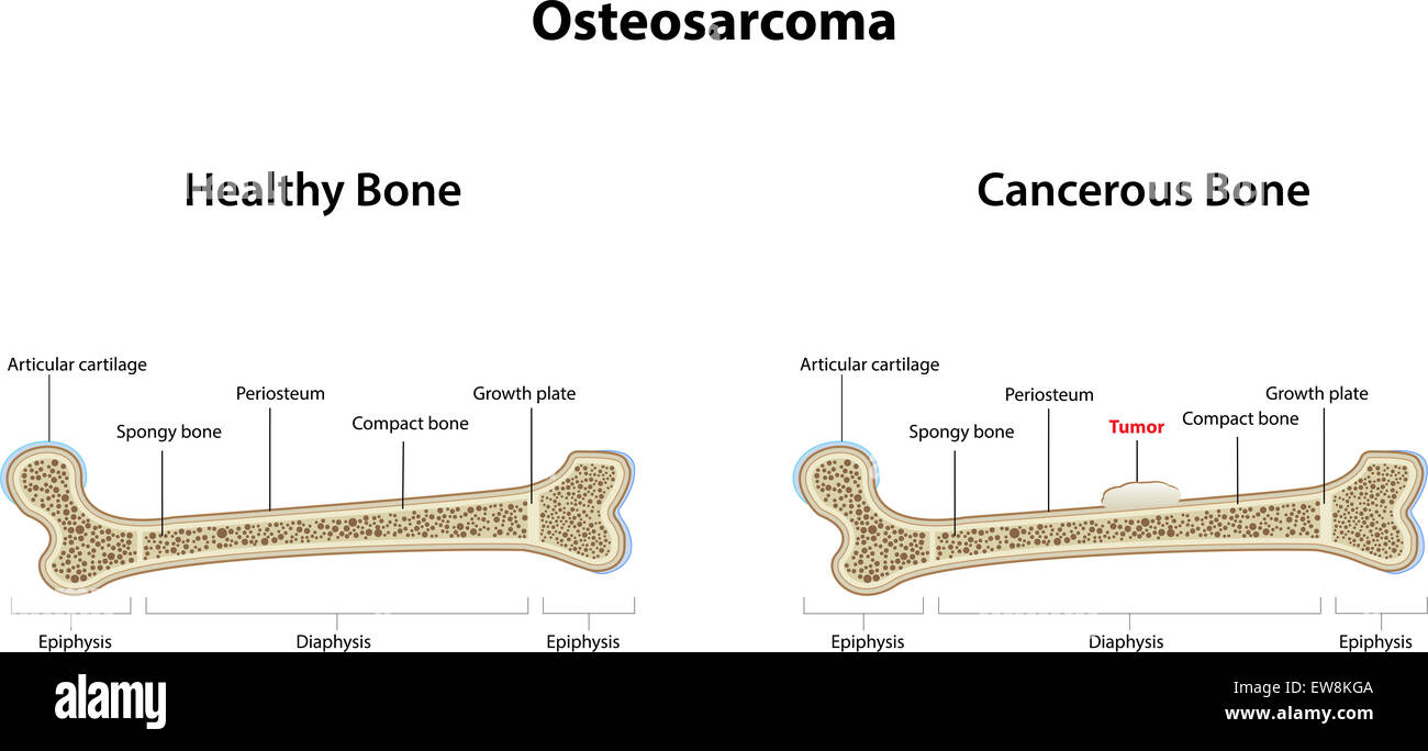 Osteosarcoma Stock Photo