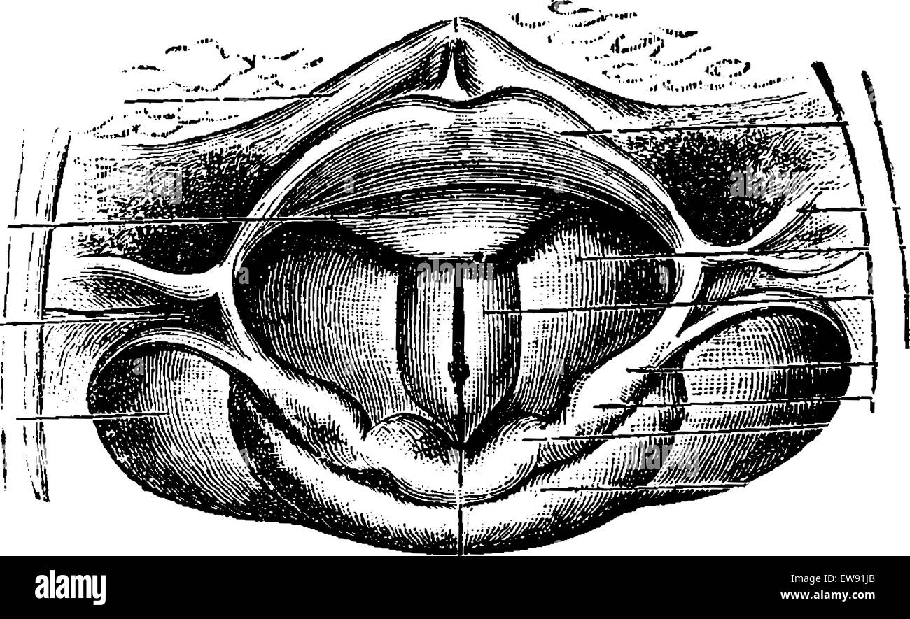 Normal Larynx, as seen through a Laryngoscopic Mirror, vintage engraved illustration. Usual Medicine Dictionary by Dr Labarthe - Stock Vector