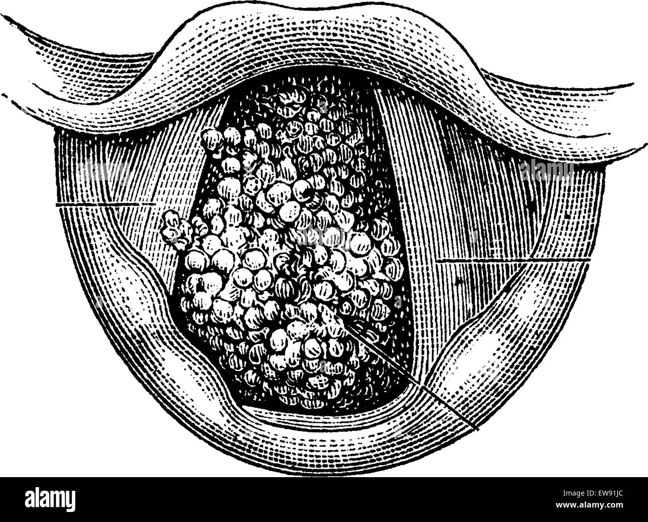 Papilloma of the Larynx, vintage engraved illustration. Usual Medicine Dictionary by Dr Labarthe - 1885 Stock Vector