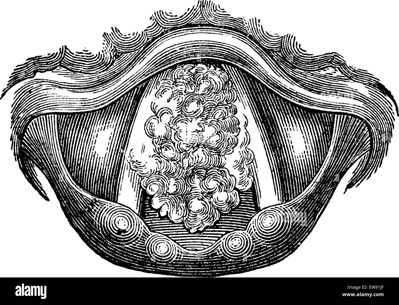 Myxoma of the Larynx, vintage engraved illustration. Usual Medicine Dictionary by Dr Labarthe - 1885 Stock Vector
