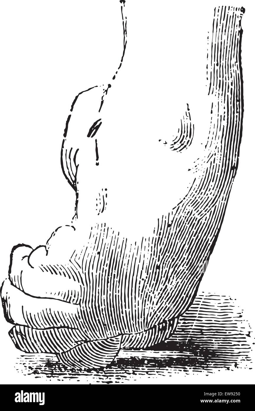 Talipes equinovarus hires stock photography and images Alamy