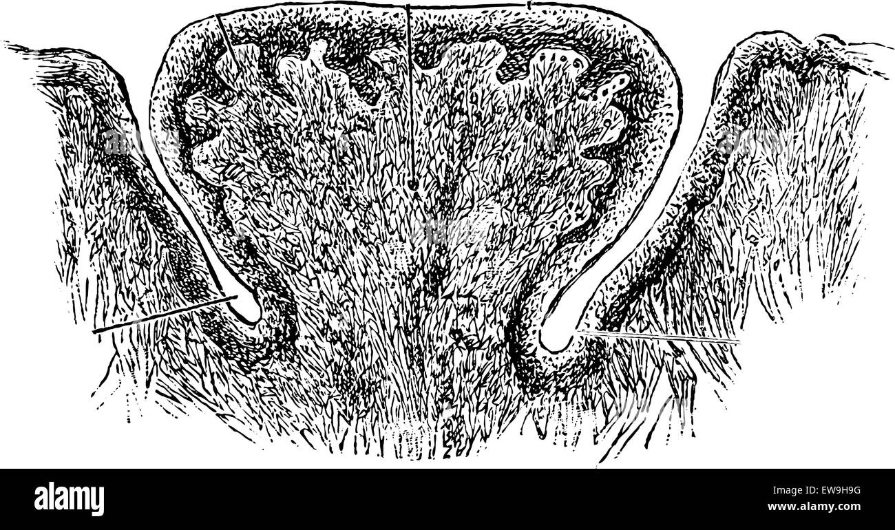 Vallate Papilla of the Human Tongue, at high magnification, vintage engraved illustration. Usual Medicine Dictionary by Dr Labar Stock Vector